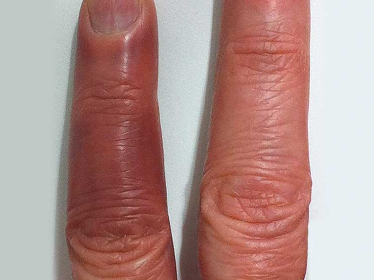 What's behind this suddenly bruised finger? AusDoc