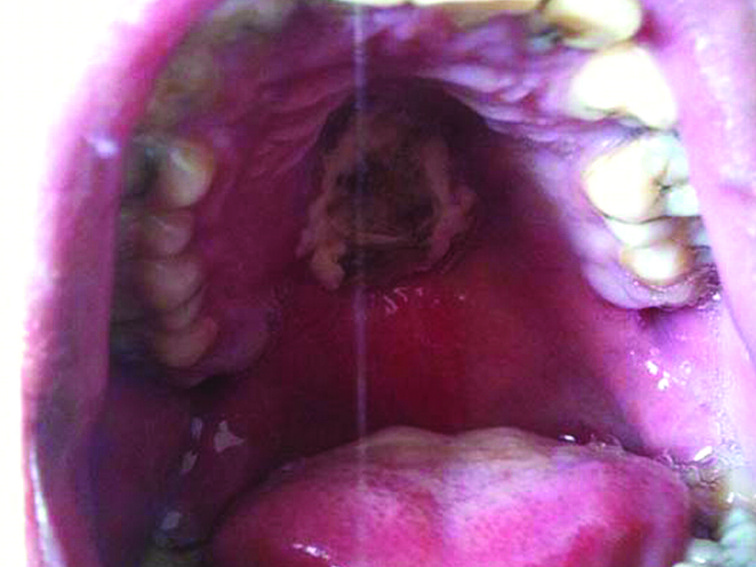 what-s-causing-this-hard-palate-lesion-ausdoc