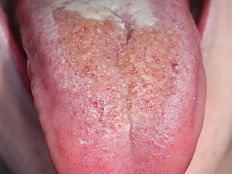 Spot Dx — What's causing these tongue blisters?