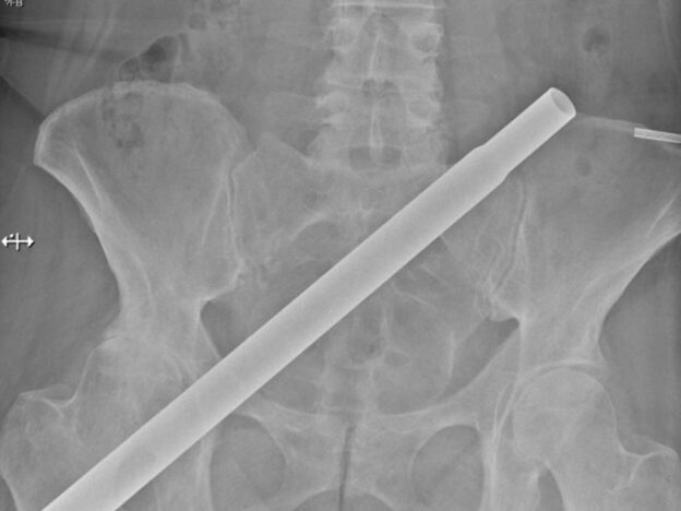 Medical Must-See: Patient impaled by her Christmas tree