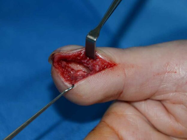 Medical Must-See: Doctors discover 'tuft' of fur inside patient's thumb