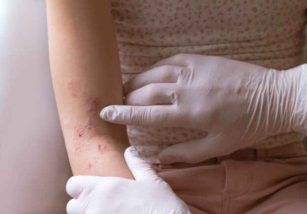 Mild eczema in young children likely to resolve by Year 6