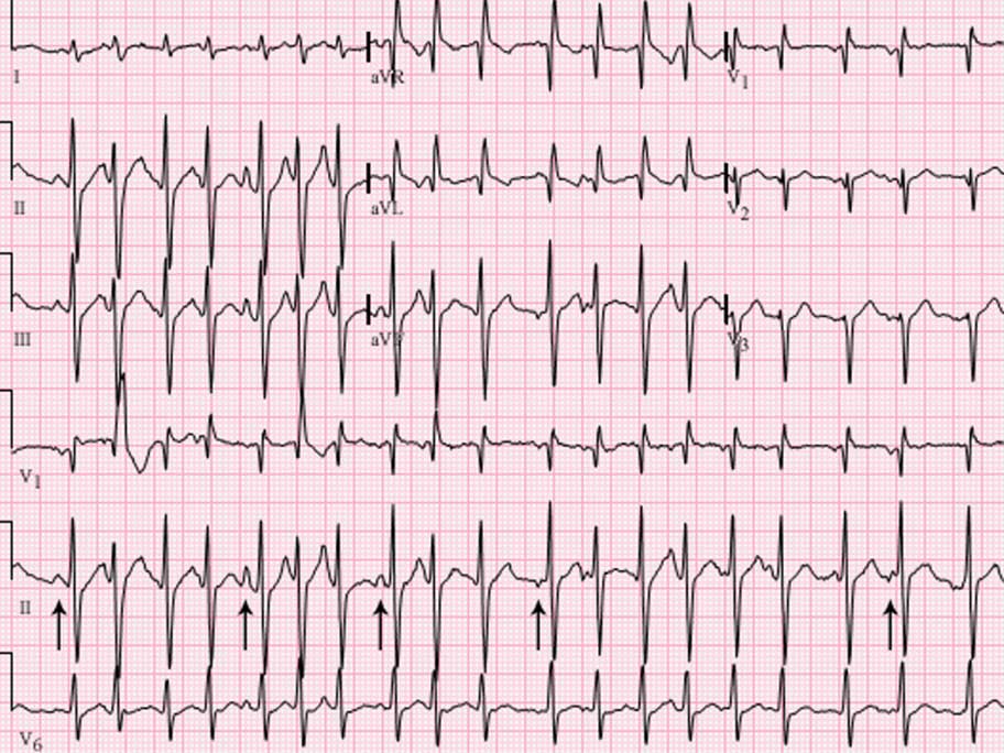 Spot Dx — Is this irregular rapid pulse an ominous sign? | AusDoc