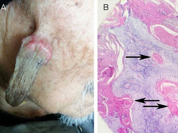 Medical Must-See: A facial horn 10 years in the making