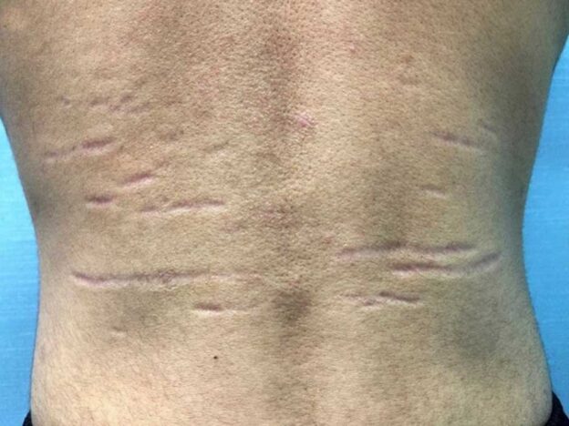 Spot Dx — What’s causing these marks?