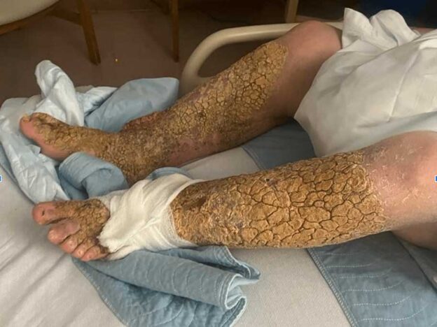 Medical Must-See: Venous insufficiency leads to 'tree bark' legs