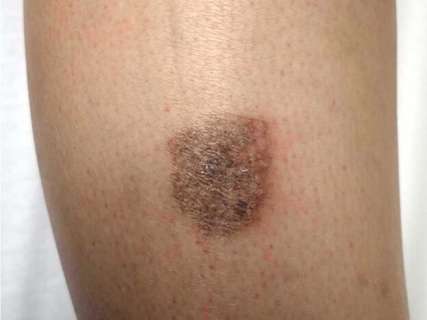 Spot Dx — What's causing these puzzling itchy purple papules?