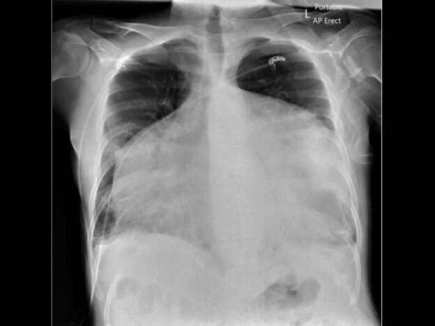 Spot Dx — X-ray clue to chest complaint