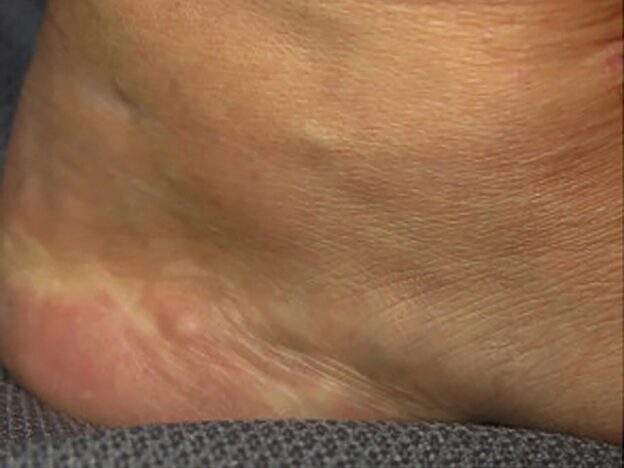 Spot Dx — Puzzling papules appear on heels 