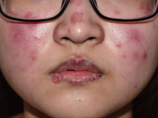 Spot Dx — What’s behind this rash?