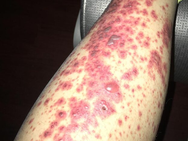 Medical Must-See: IV antibiotic kicks off purpuric rash