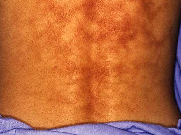 Spot Dx — What’s behind this itchy rash?