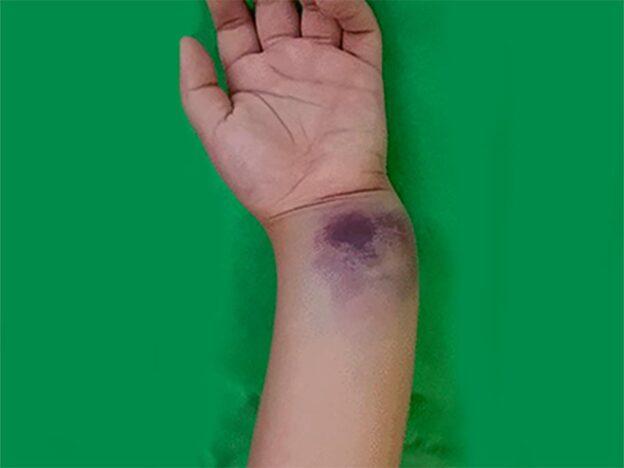 Spot Dx — Fall puts wrist out of joint