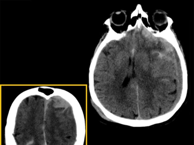 Spot Dx — What does this head CT show?