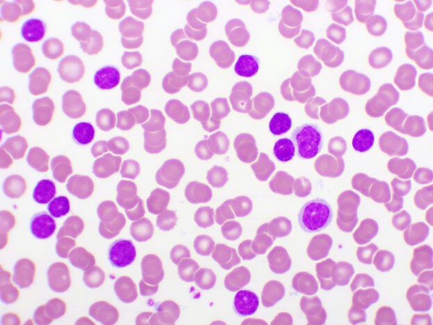 $190,000 combination therapy for blood cancer listed on the PBS