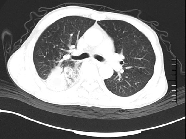 Spot Dx — Is the cause of this cough out of left field?