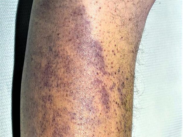 Spot Dx — Can you spot the cause of this bruising?