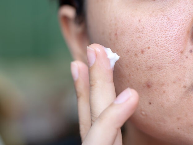 New treatment algorithm for mild-moderate acne