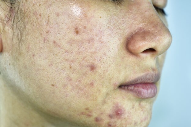 Treating acne in 2024: a best practice approach and expert discussion