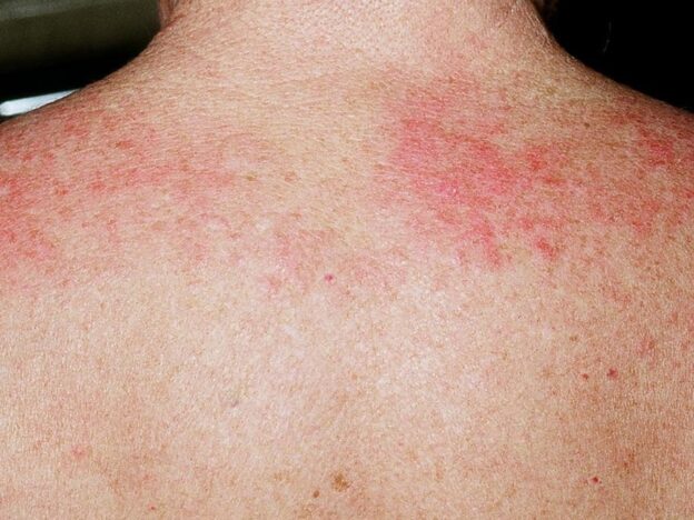 Spot Dx — What is causing this pruritic rash with associated weakness?