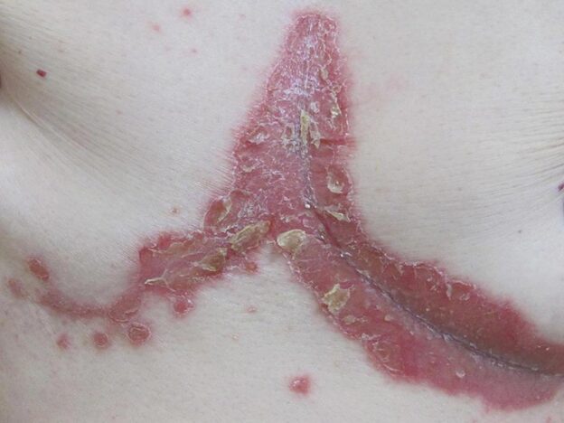 Spot Dx — Pruritic rash puzzles patient