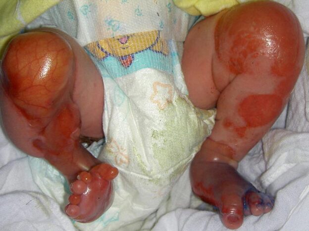 Spot Dx — What’s behind this infant’s rash?