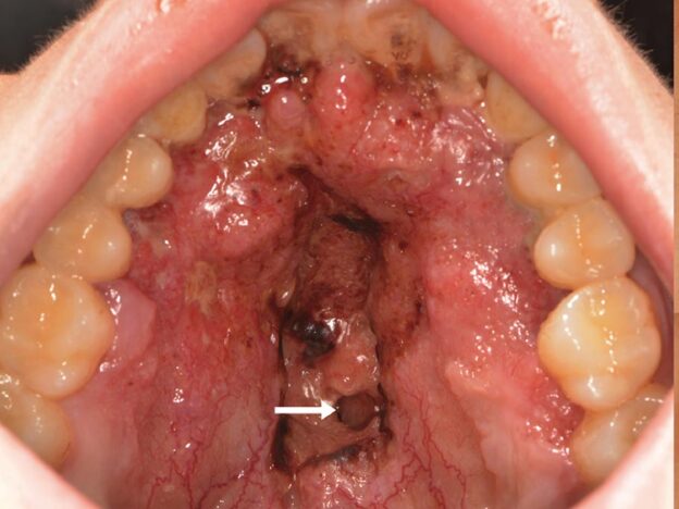 Medical Must-See: Perforated palate points to rare fungal infection