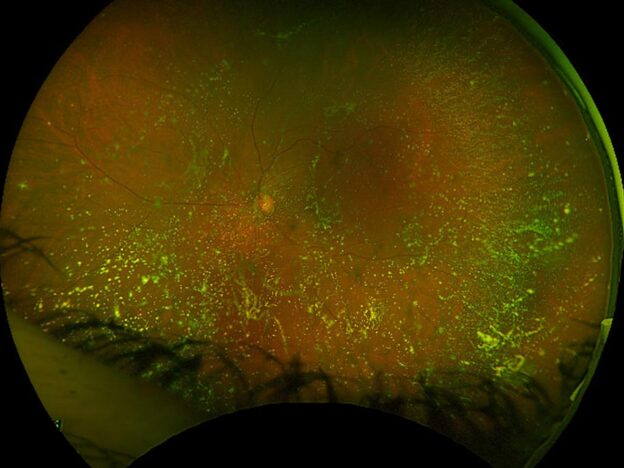 Spot Dx — Gaze at these fundal findings