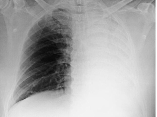 Medical Must-See: Patient's collapsed lung has fungal origins