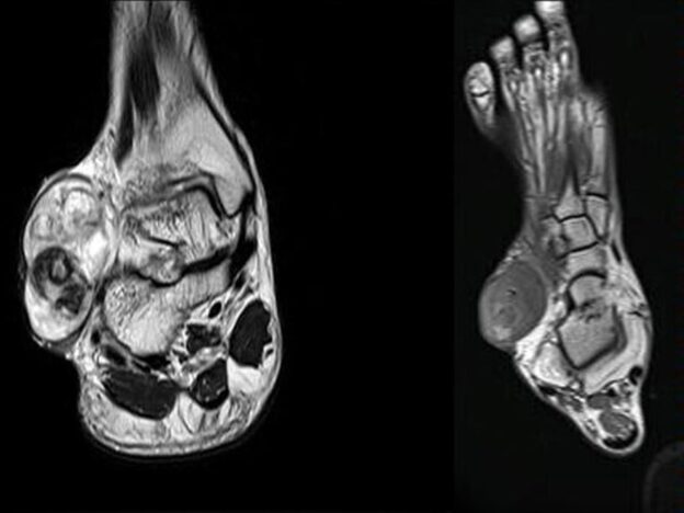 Medical Must-See: Patient withstands 'glistening white’ foot tumour for three years