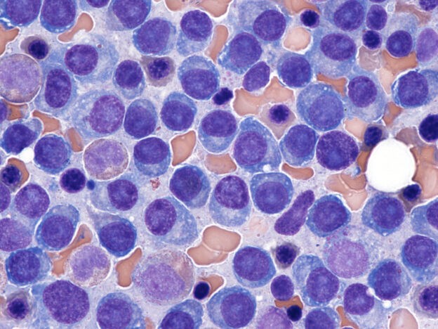 Leading haematologist reveals clinical pearls for diagnosing multiple myeloma