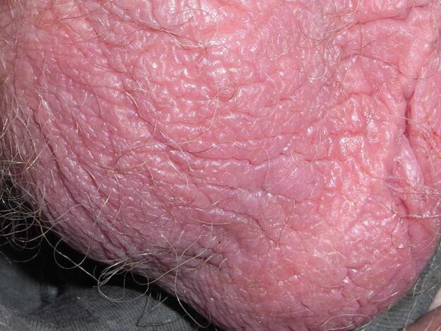 Spot Dx — What's the cause of this scrotal rash?