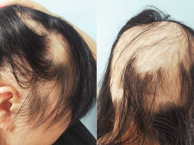 Spot Dx — What's behind this sudden hair loss?