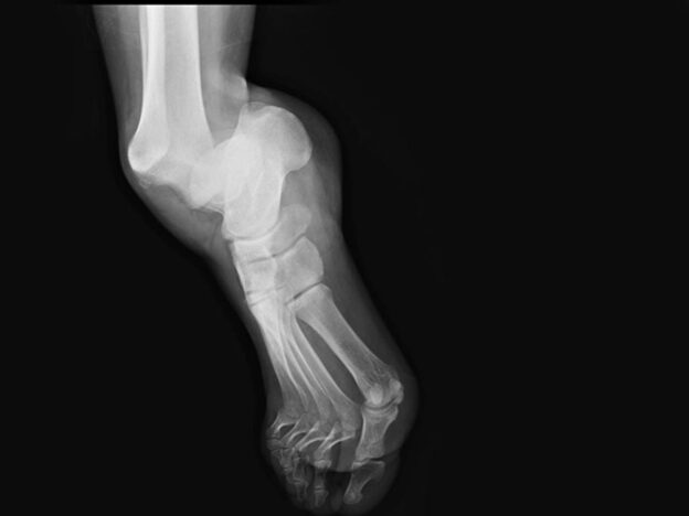 Medical Must-See: Extremely rare case of pure ankle dislocation