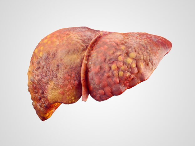 Diabetes in NAFLD drives high rate of decompensated cirrhosis: Aussie study