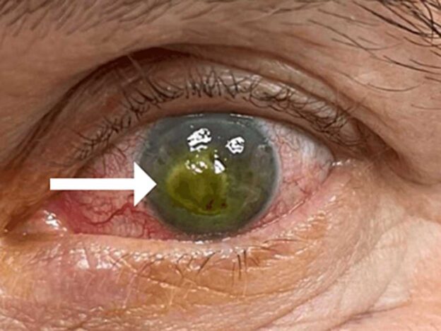 Medical Must-See: Sunscreen, sweat and a rare corneal ulcer