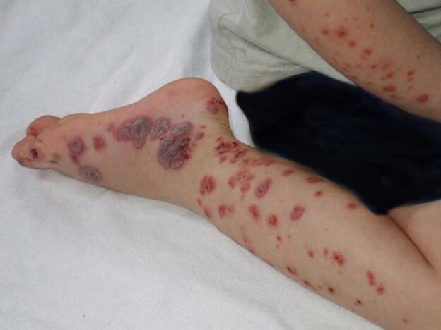 Spot Dx — What is behind this child's rash?