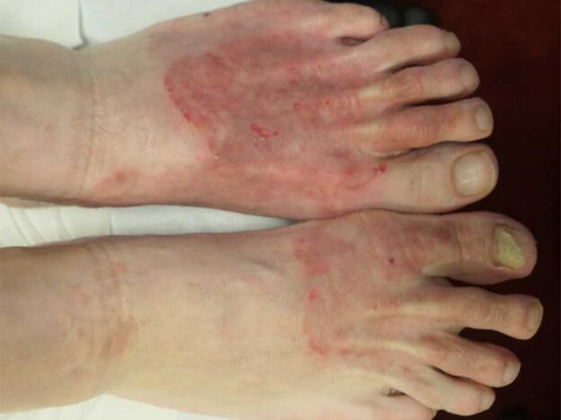 Spot Dx — Can you nail down the cause of this foot rash?