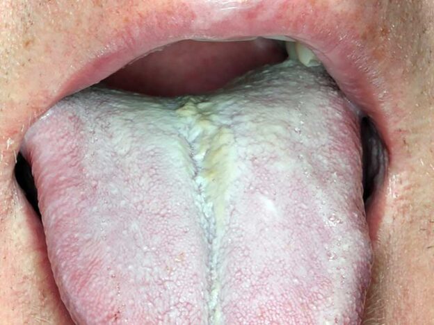 Spot Dx — Why has this tongue turned white?