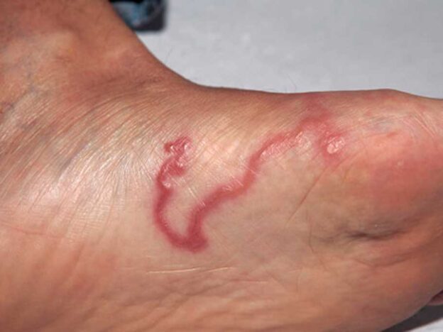 Spot Dx — What on earth is this foot lesion?