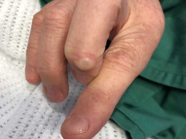 Spot Dx — What's the best cure for this finger cyst?