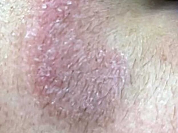 Spot Dx — What's this stubborn rash post-waxing?