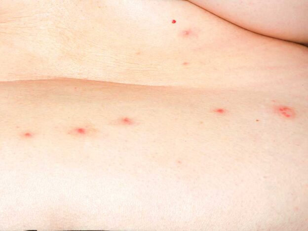 Spot Dx — What's behind this holiday rash?