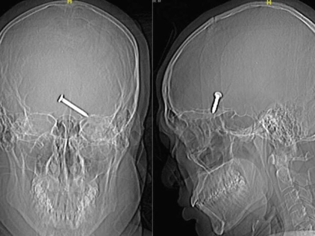 Medical Must-See: Man survives accidentally shooting nail into his eye