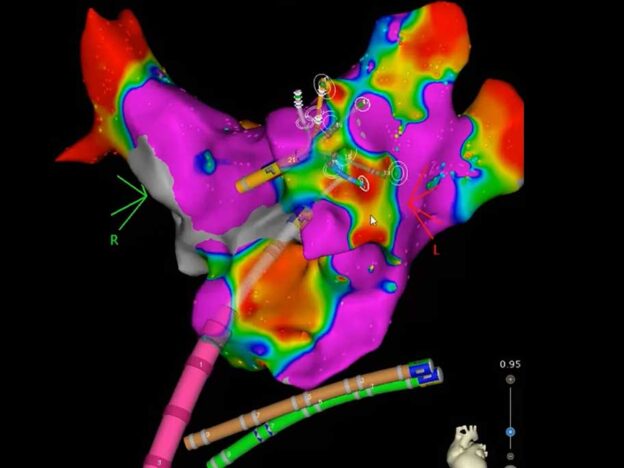 A GP guide to catheter ablation for AF