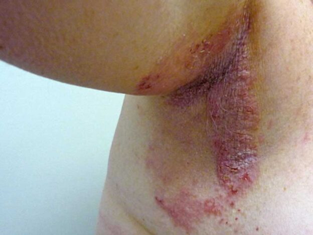 Spot Dx — Can you puzzle out these painful, pruritic lesions?