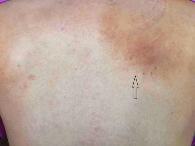 Spot Dx — Itching to diagnose this tingling scapula?