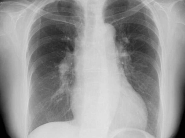 Spot Dx — What's behind this dyspnoea?