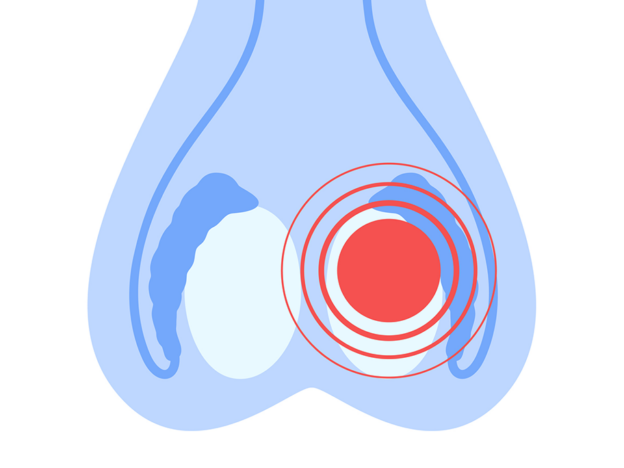 Mid-coital testicular pain strikes out of the blue