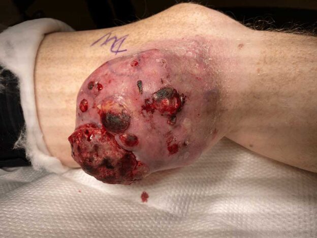 Medical Must-See: First case of giant malignant melanoma on the leg